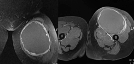 Figure 4 for case Benign Fibrous Histiocytoma